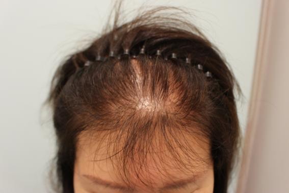 여성분이 탈모 있으시면 참고하세요..