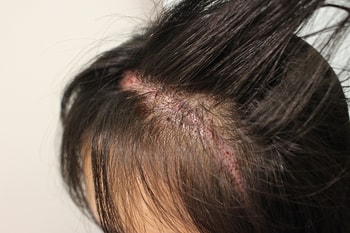 이식부위,비절개로2천모