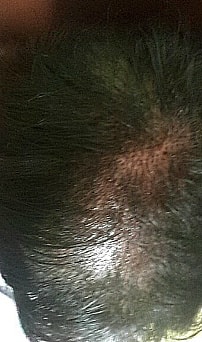 수술받은 당일 저녁에 찍은사잔입니다