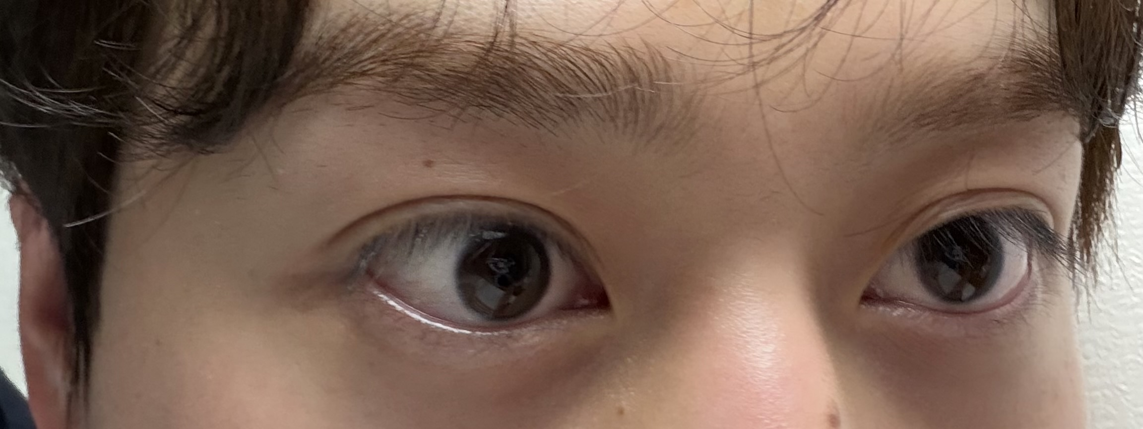 쌍수가 잘 안 돼서 눈재수술 했습니다