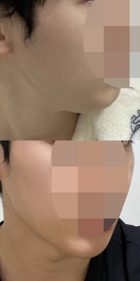 얼굴지방흡입했습니다.