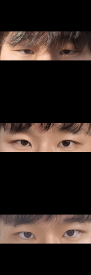 쌍커풀, 눈매교정 수술한지 4달