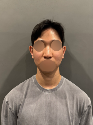 네임드 코성형 후기