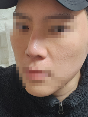 코재수술 2개월차 후기 휘어진 콧대, 쏘핏으로 제대로 잡았습니다