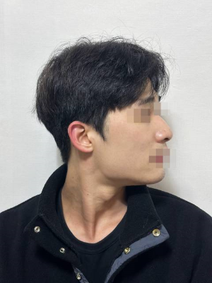 콧대,매부리,복코 수술후기