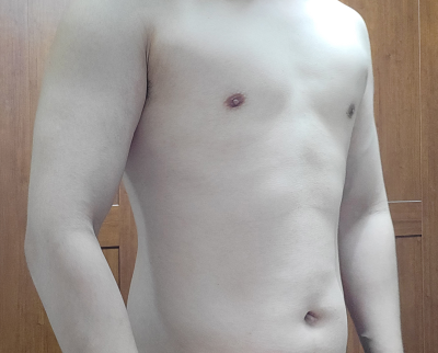 디에이성형외과의원 / 여유증수술+부유방제거 받았습니다.