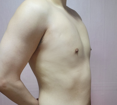 여유증 수술 1년 후