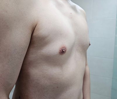 여유증 수술했습니다.