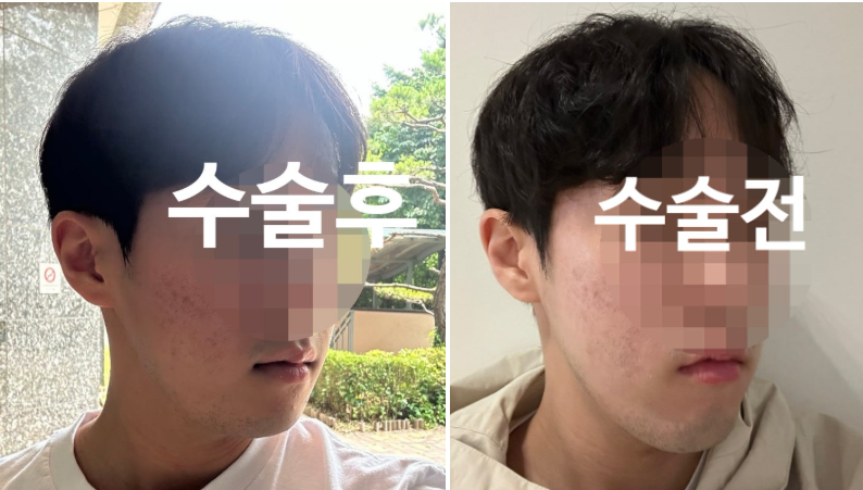jiuyvijyy님의 시술후기