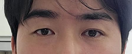 아배마리아님의 시술후기