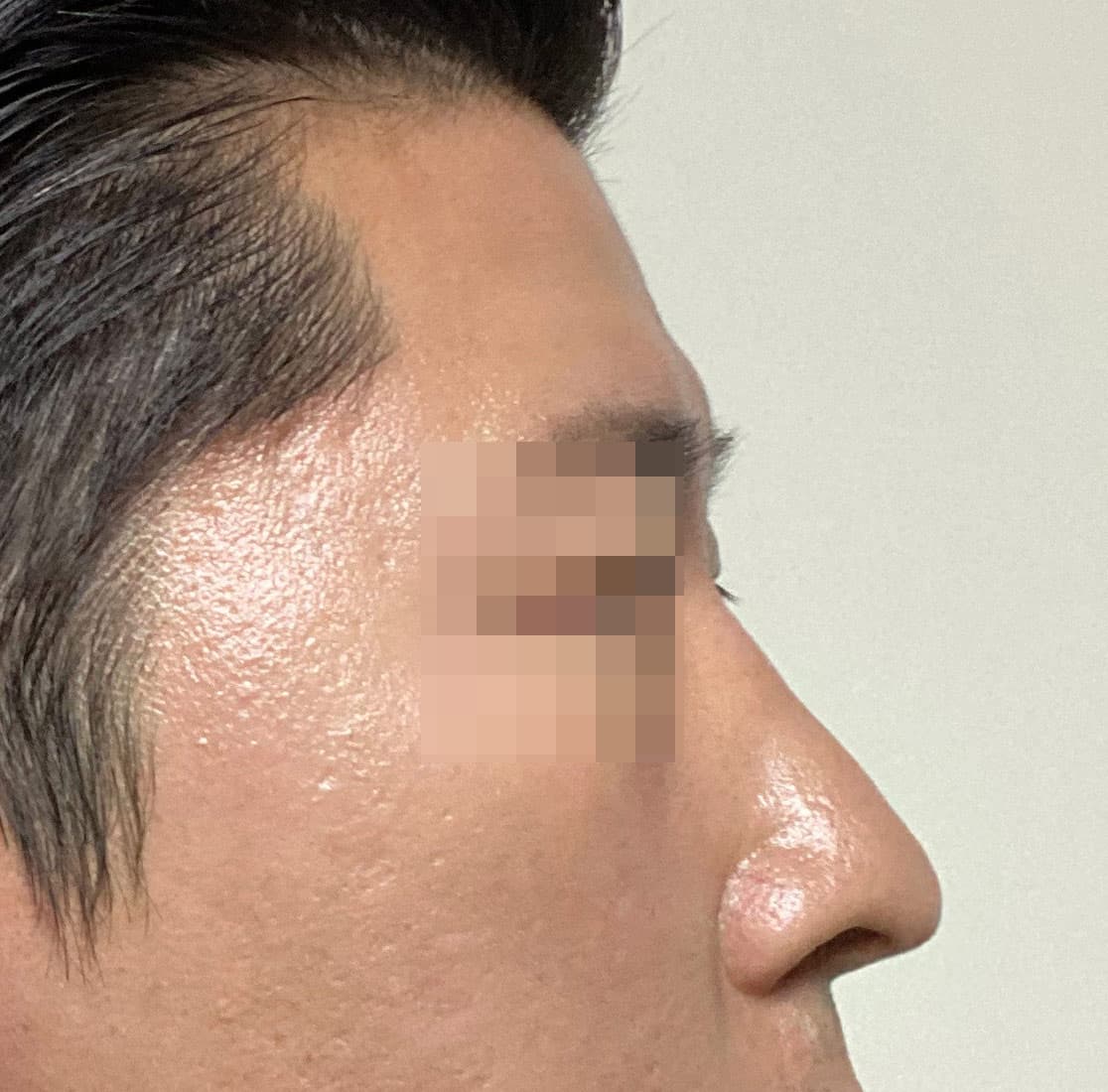 뿌리만남겨님의 시술후기