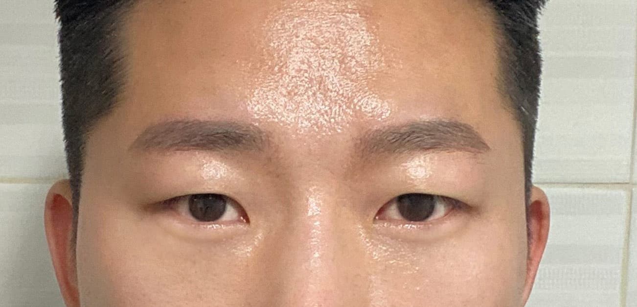 뿌리만남겨님의 시술후기