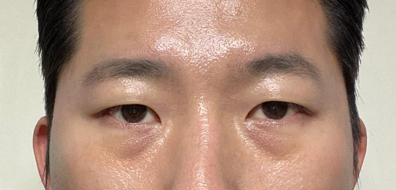 뿌리만남겨님의 시술후기