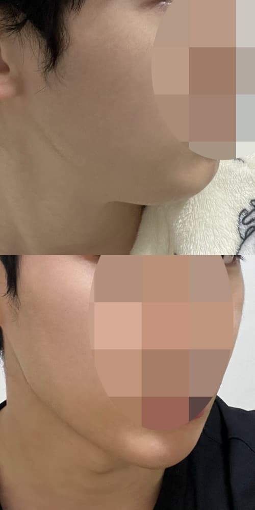 dfndwb님의 시술후기