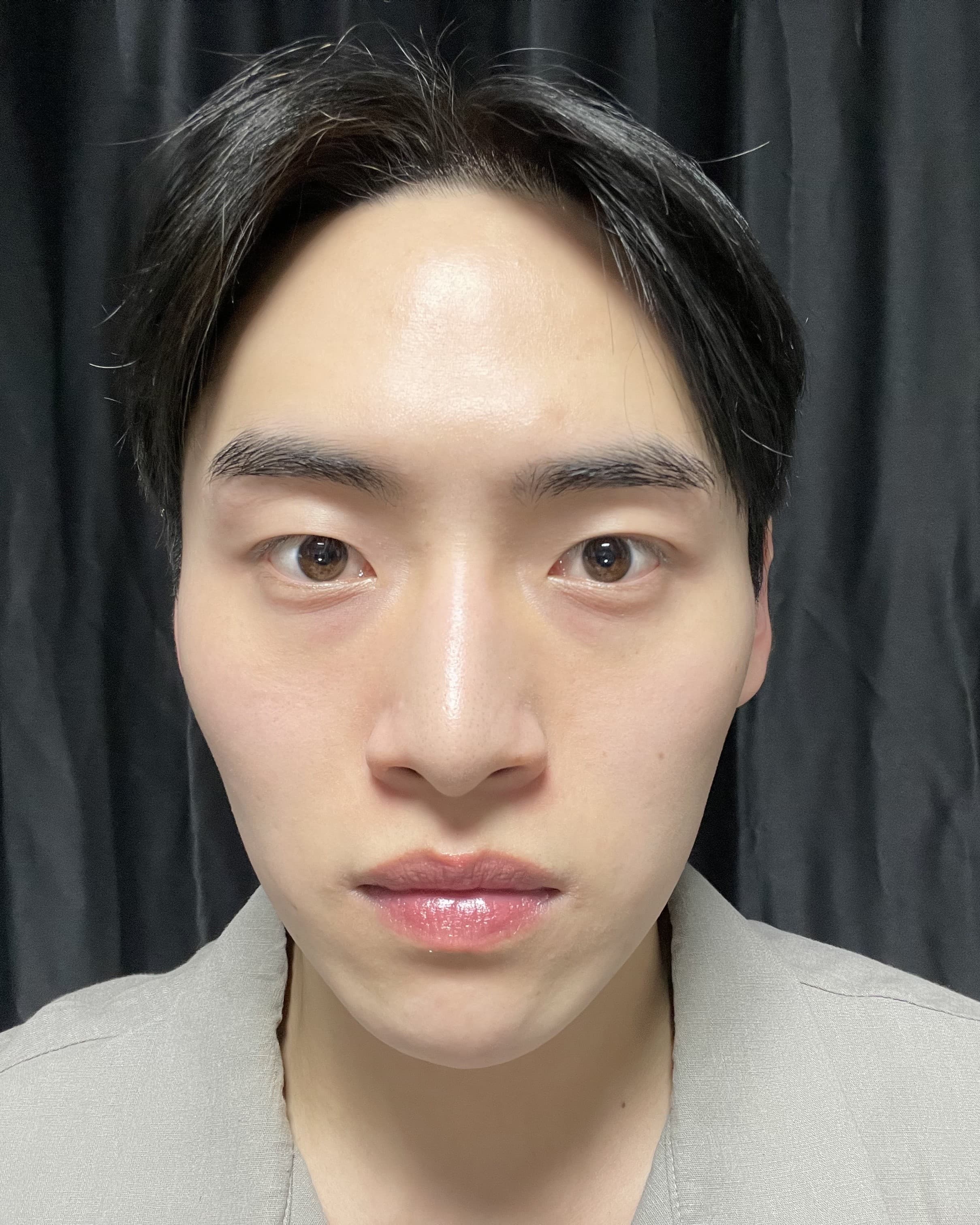 k3095485934059404593님의 시술후기
