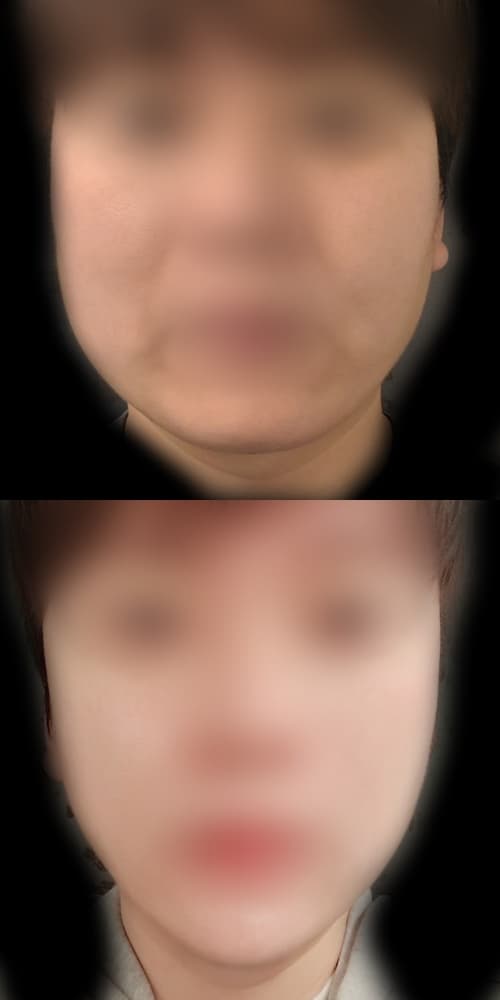 wefbjh님의 시술후기