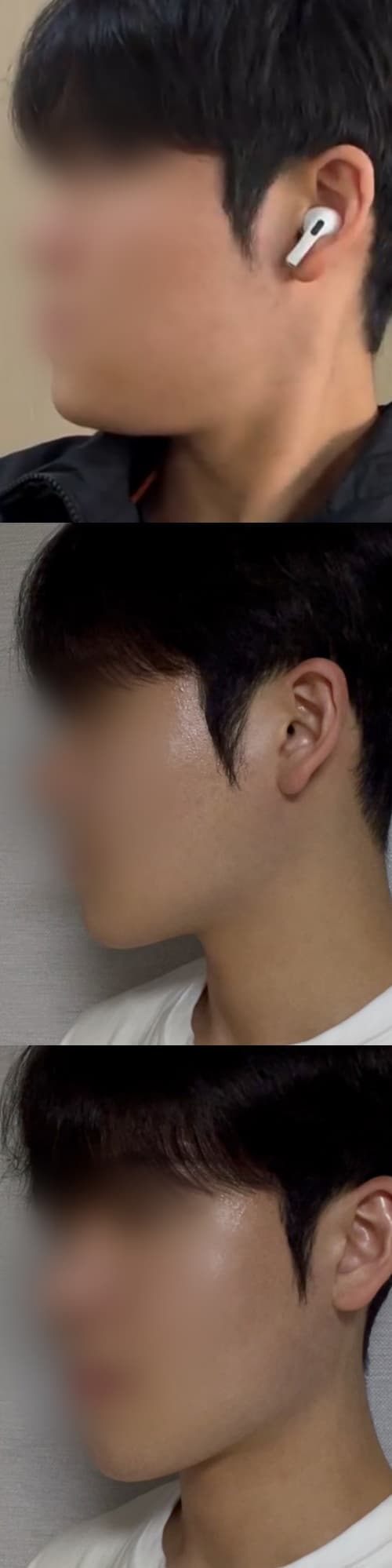 sdbnwg님의 시술후기