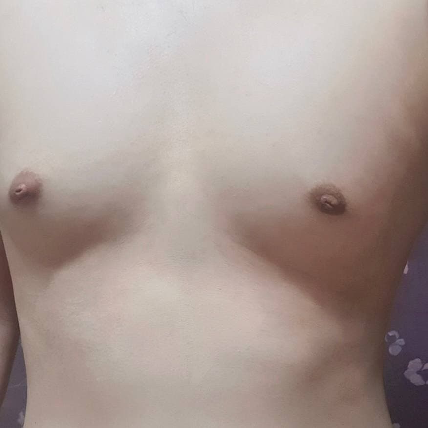 솔솔바람이님의 시술후기