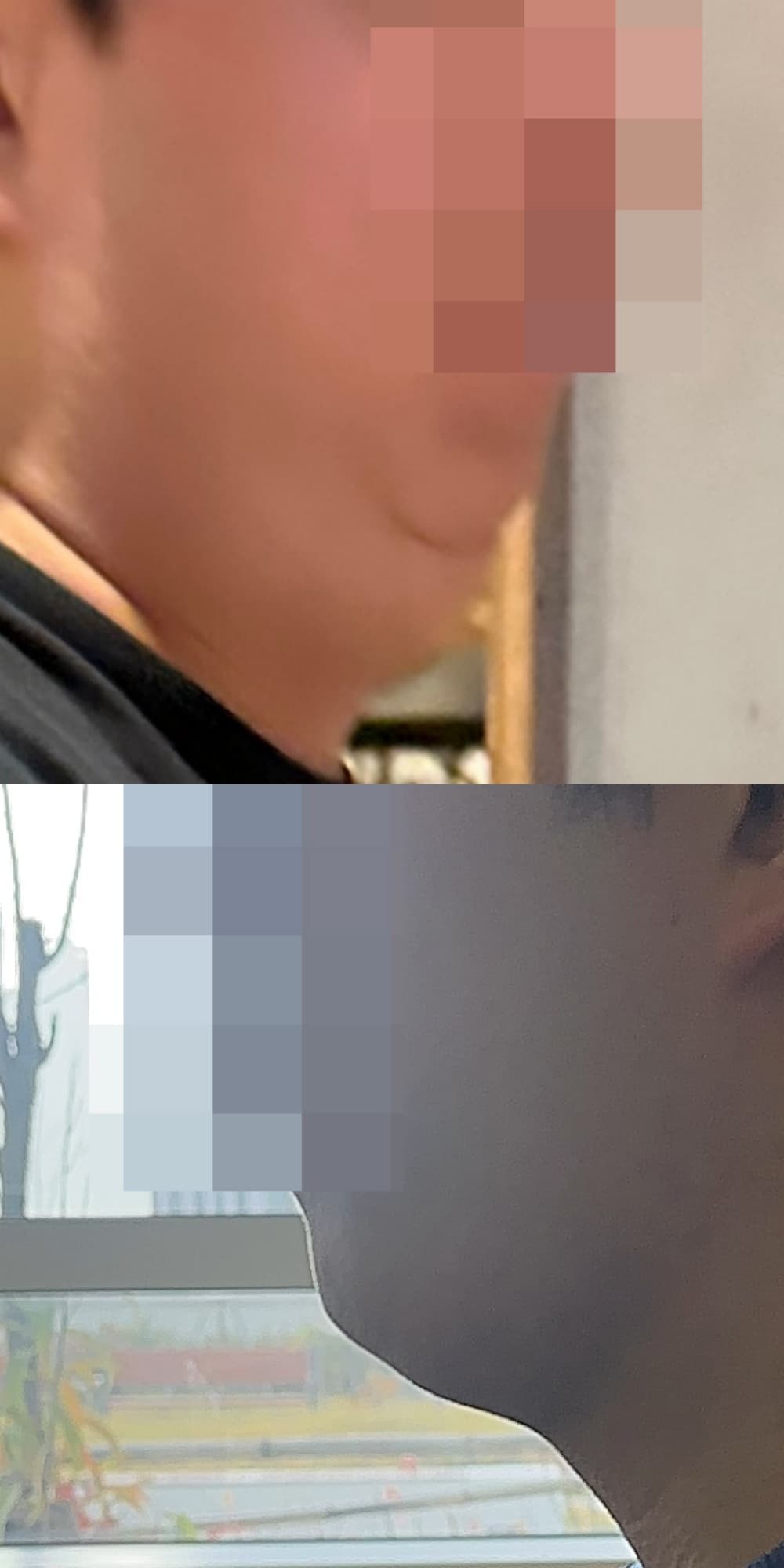 dfnbnw님의 시술후기