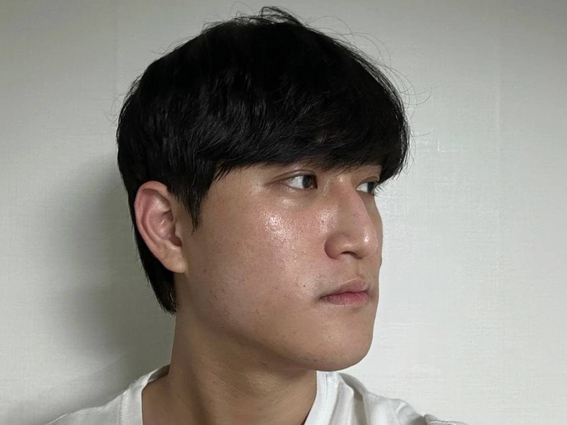 쏘소웅님의 시술후기