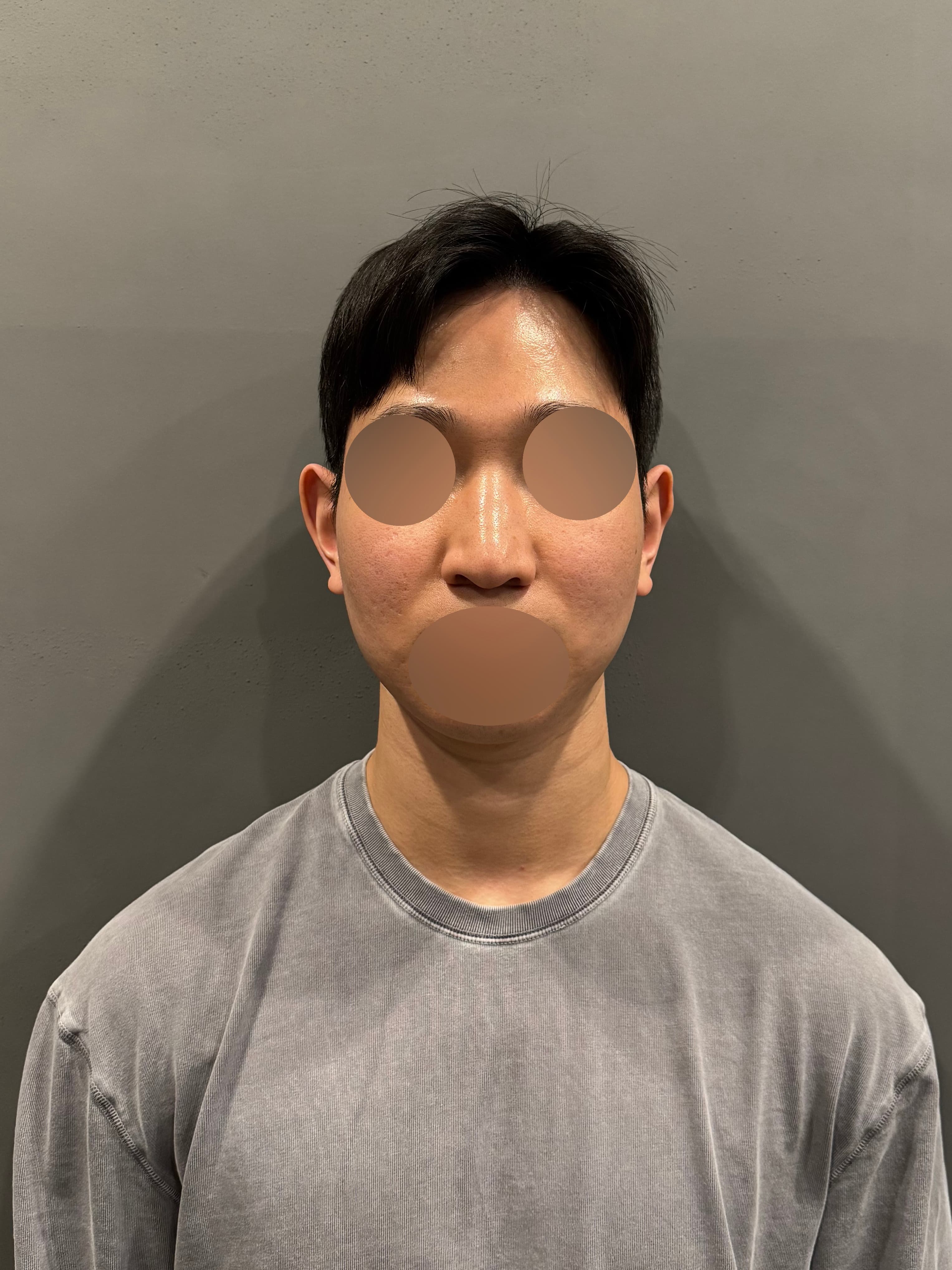 K44495448002509161357님의 시술후기