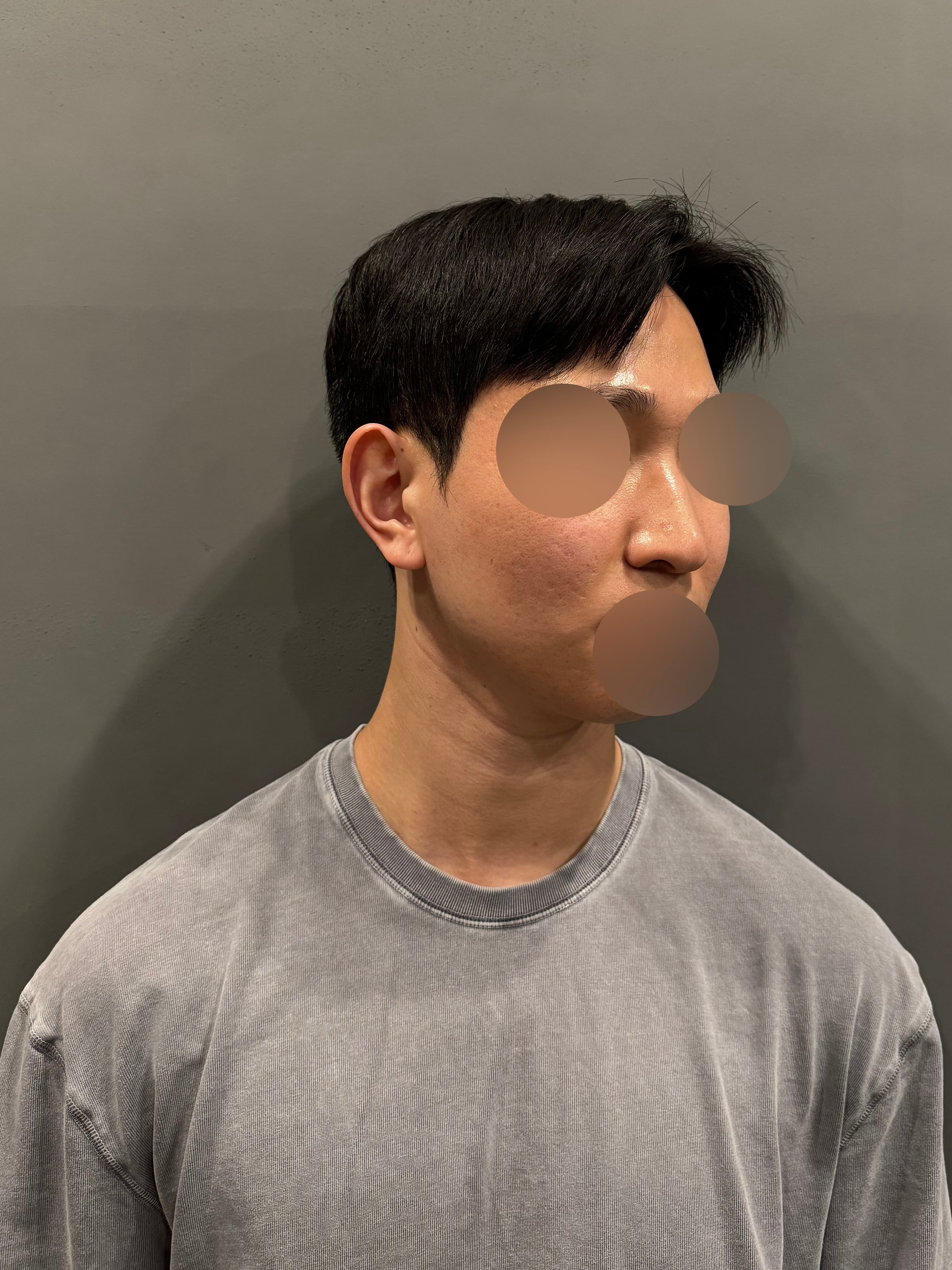 K44495448002509161357님의 시술후기
