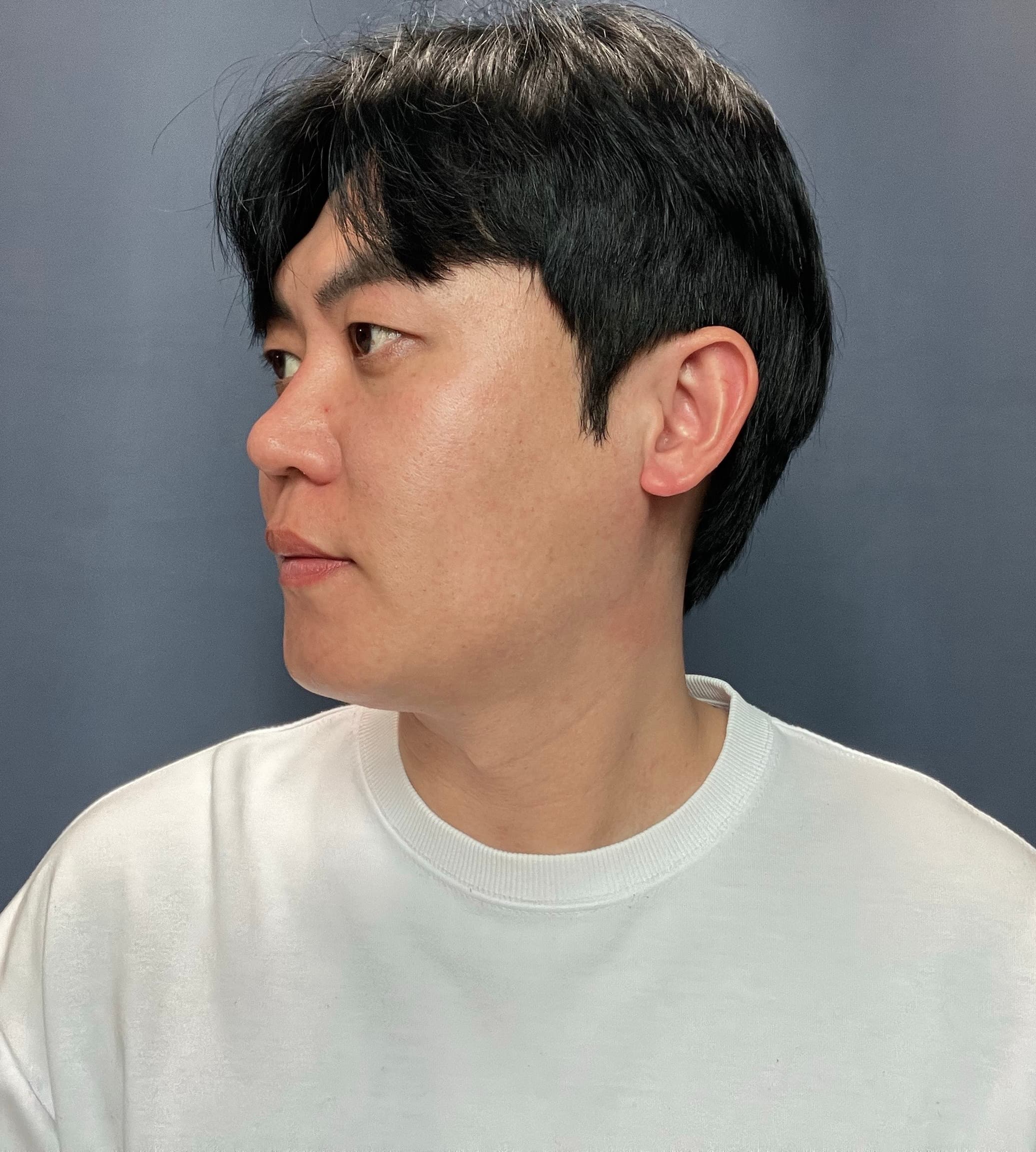 허쉬촠님의 시술후기