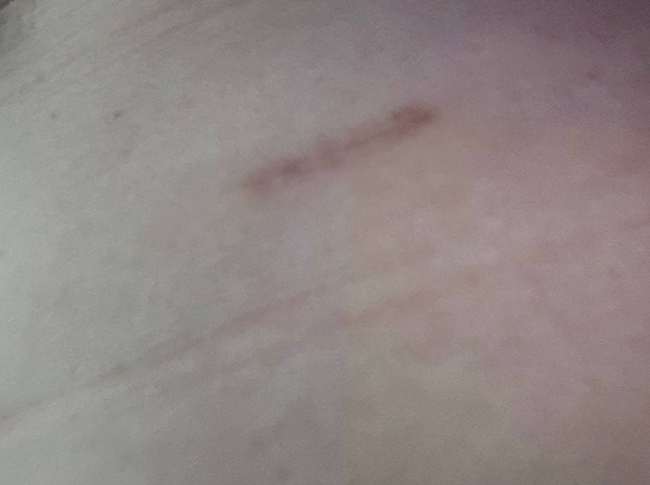 대상이다님의 시술후기