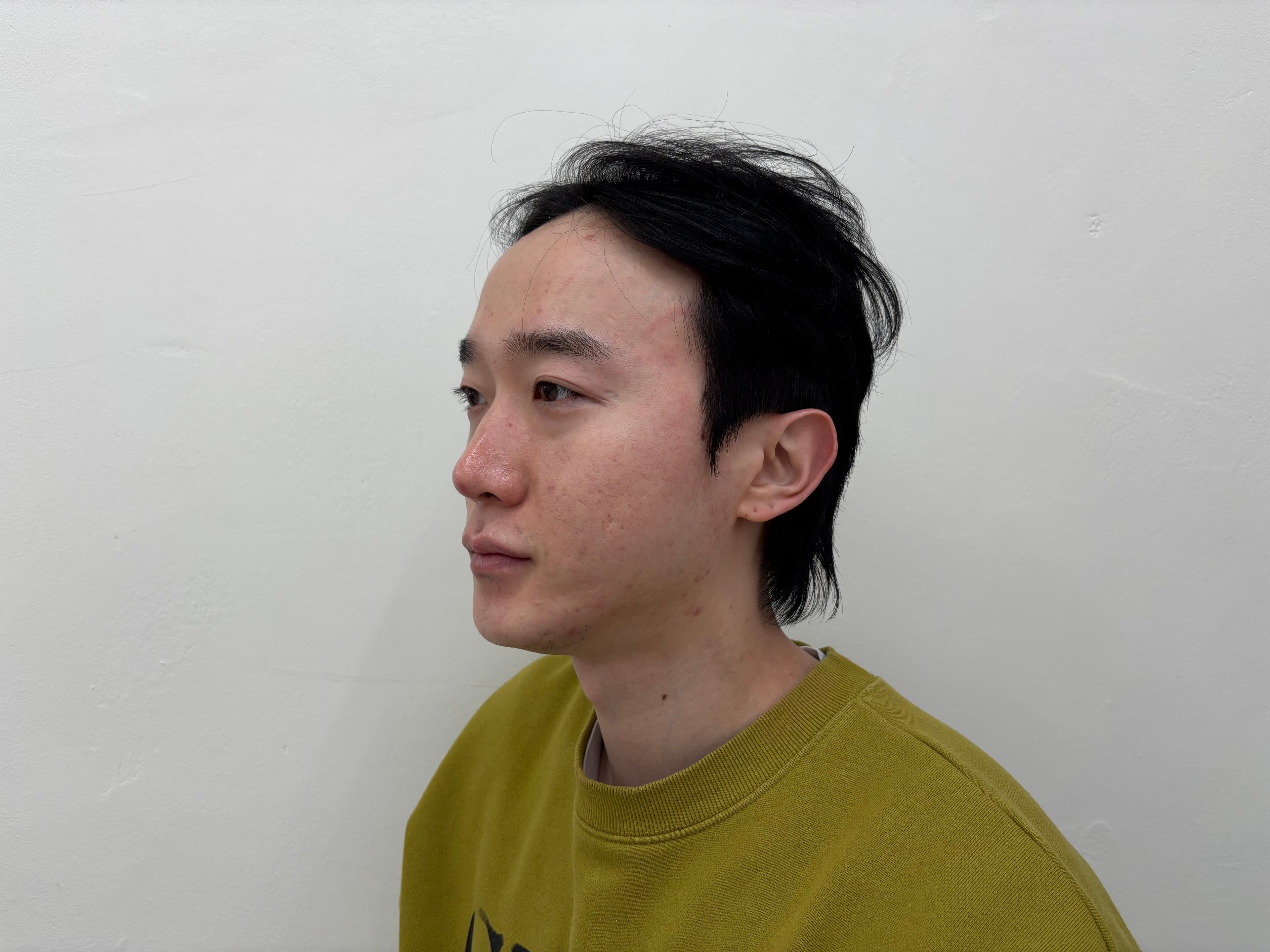 DHNWH님의 시술후기