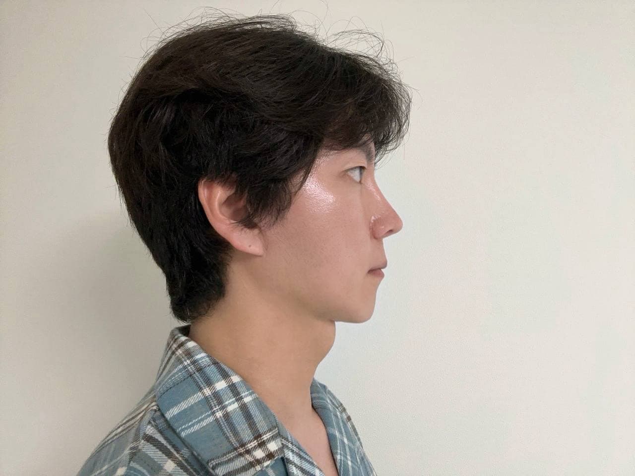 이쑤님의 시술후기