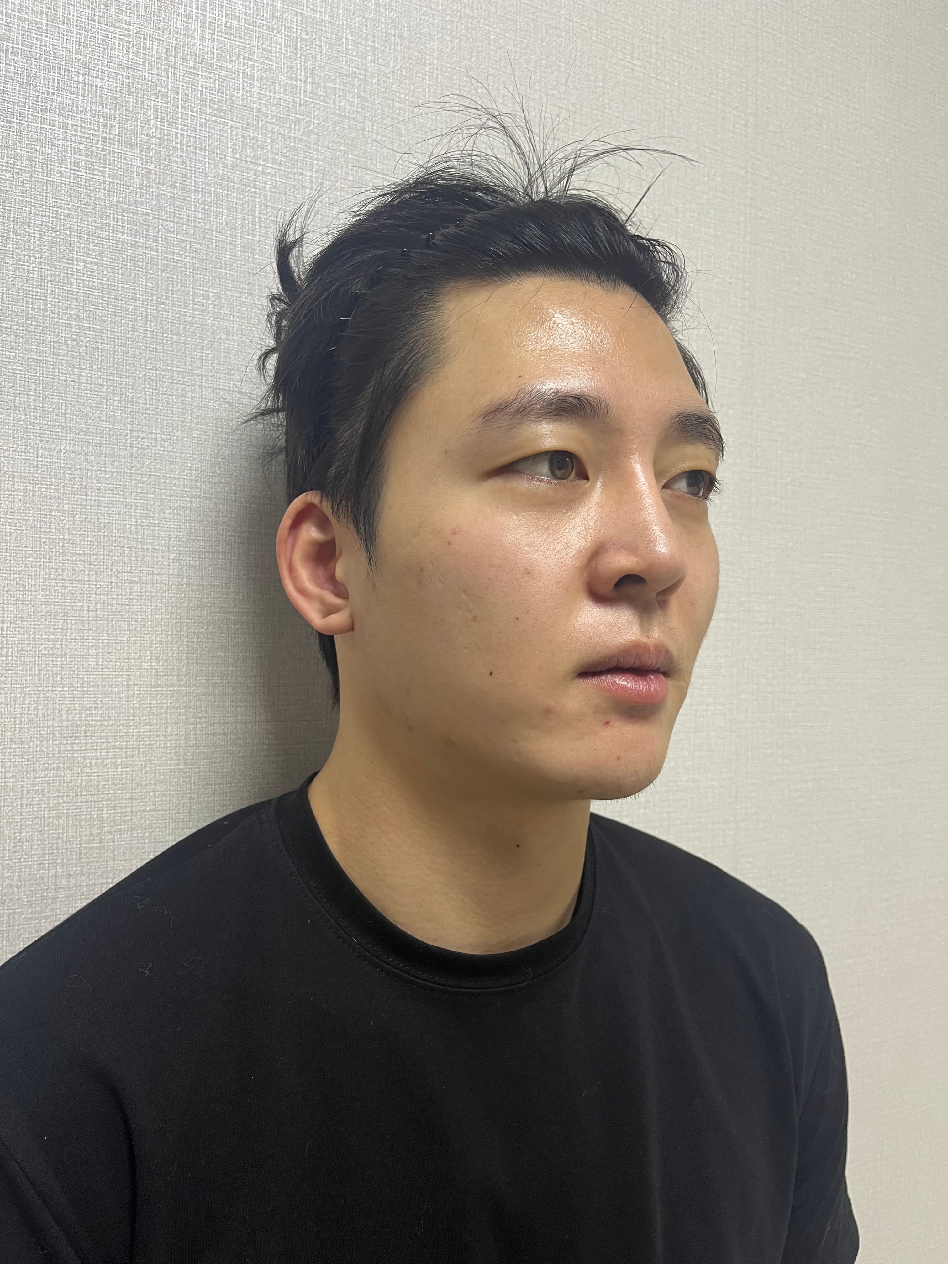 가가이기님의 시술후기