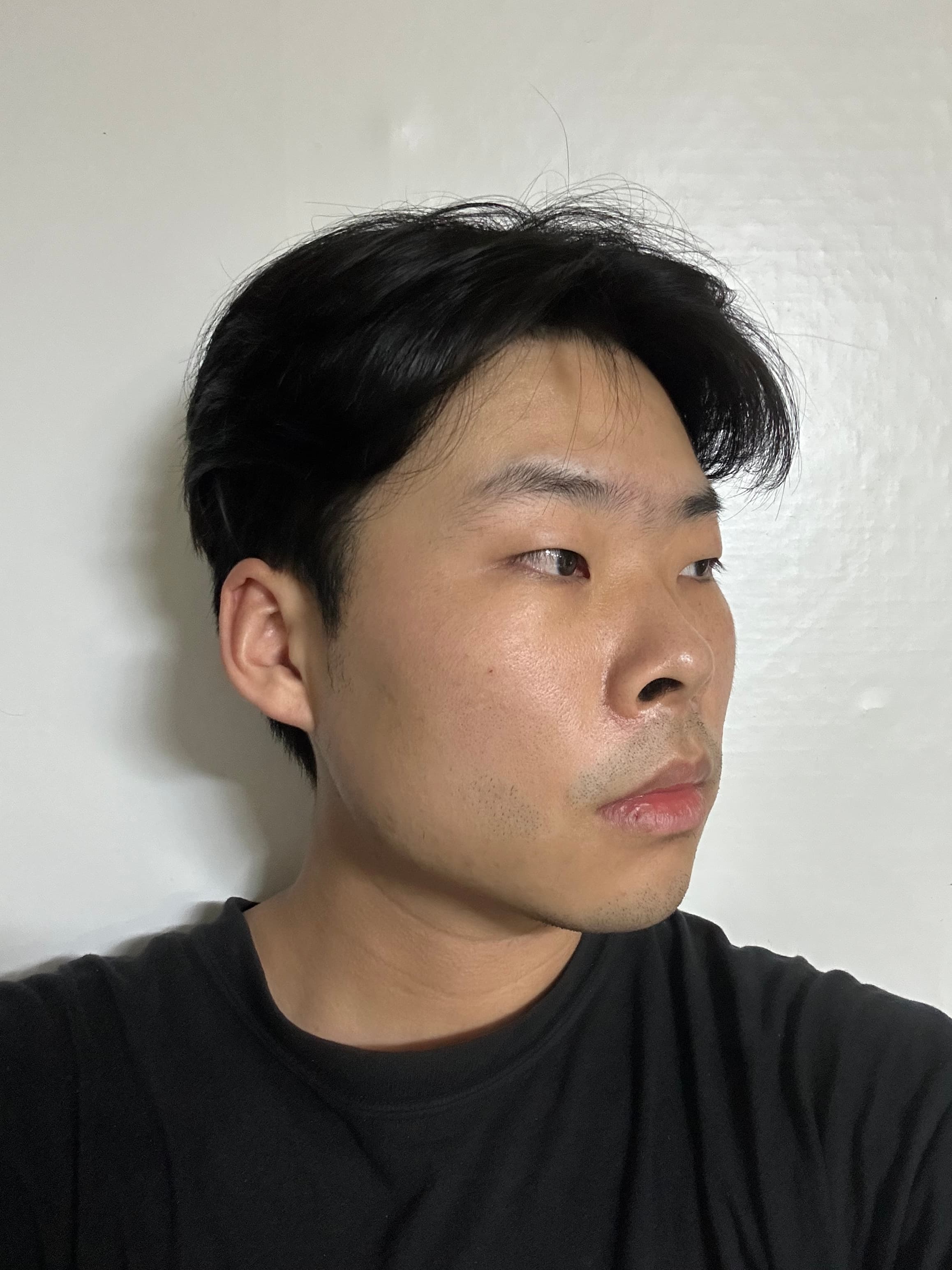 장후나링님의 시술후기