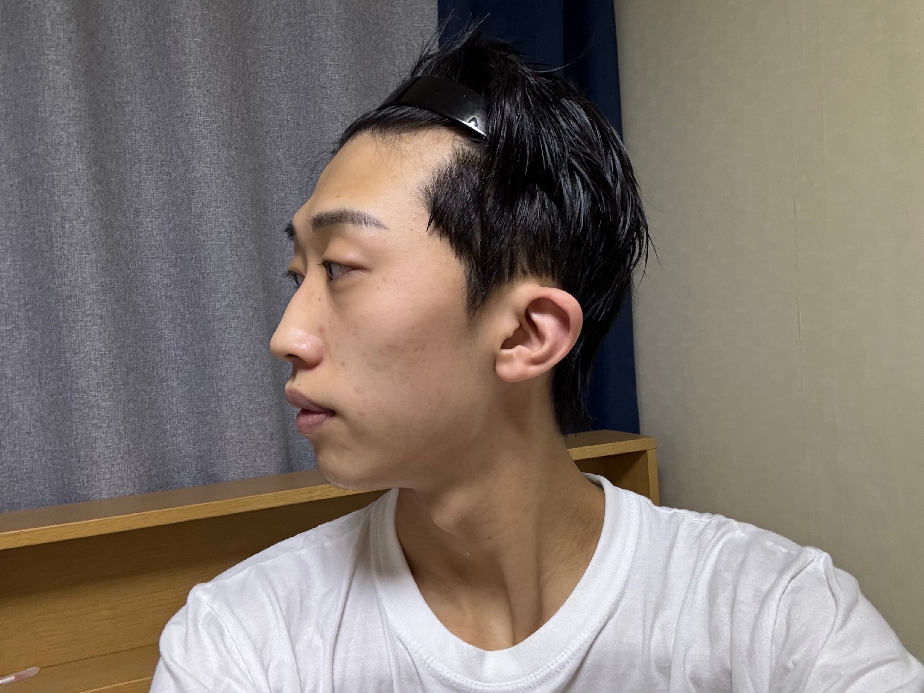 날라다녈님의 시술후기