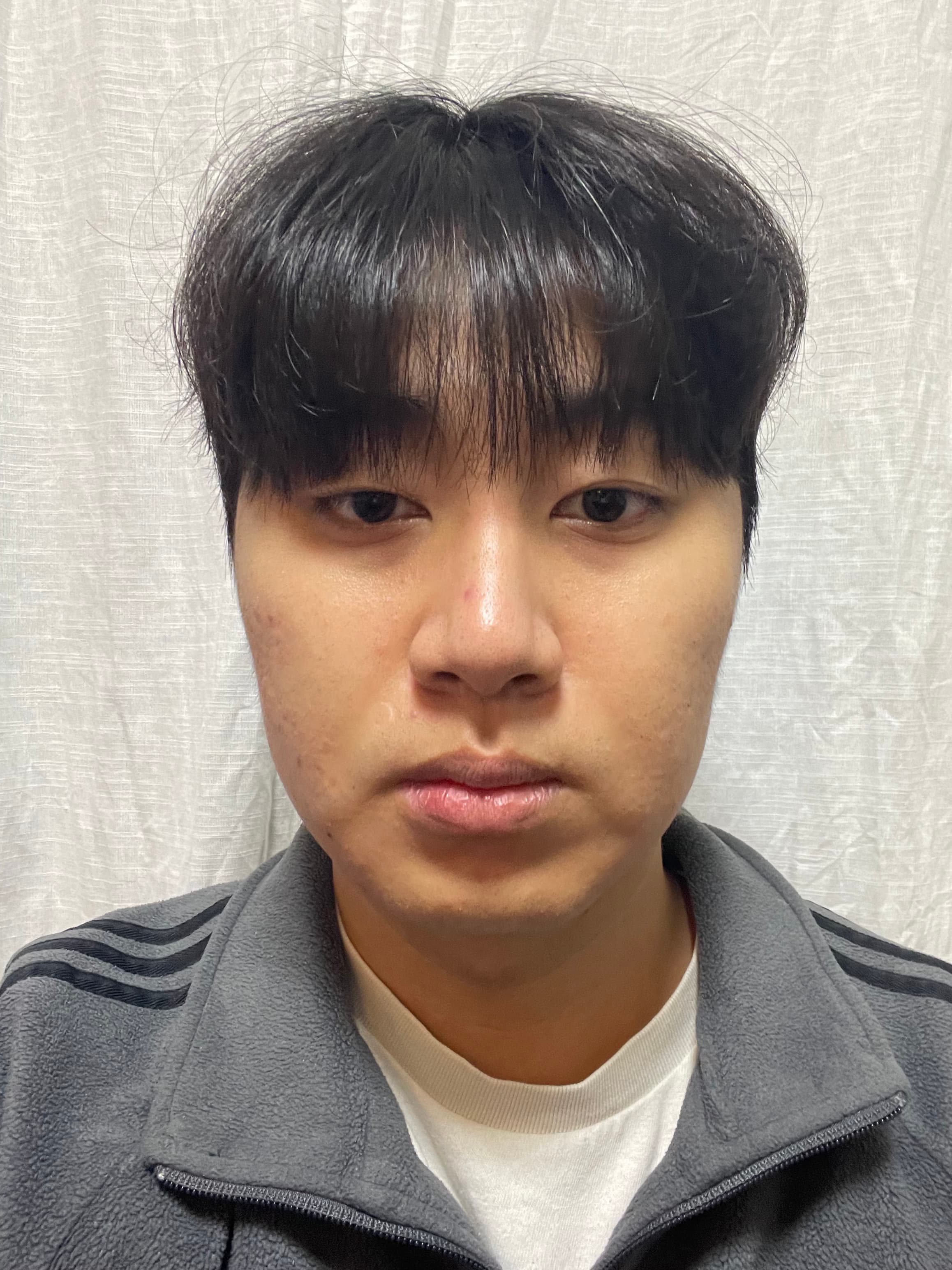 하뉴닾님의 시술후기