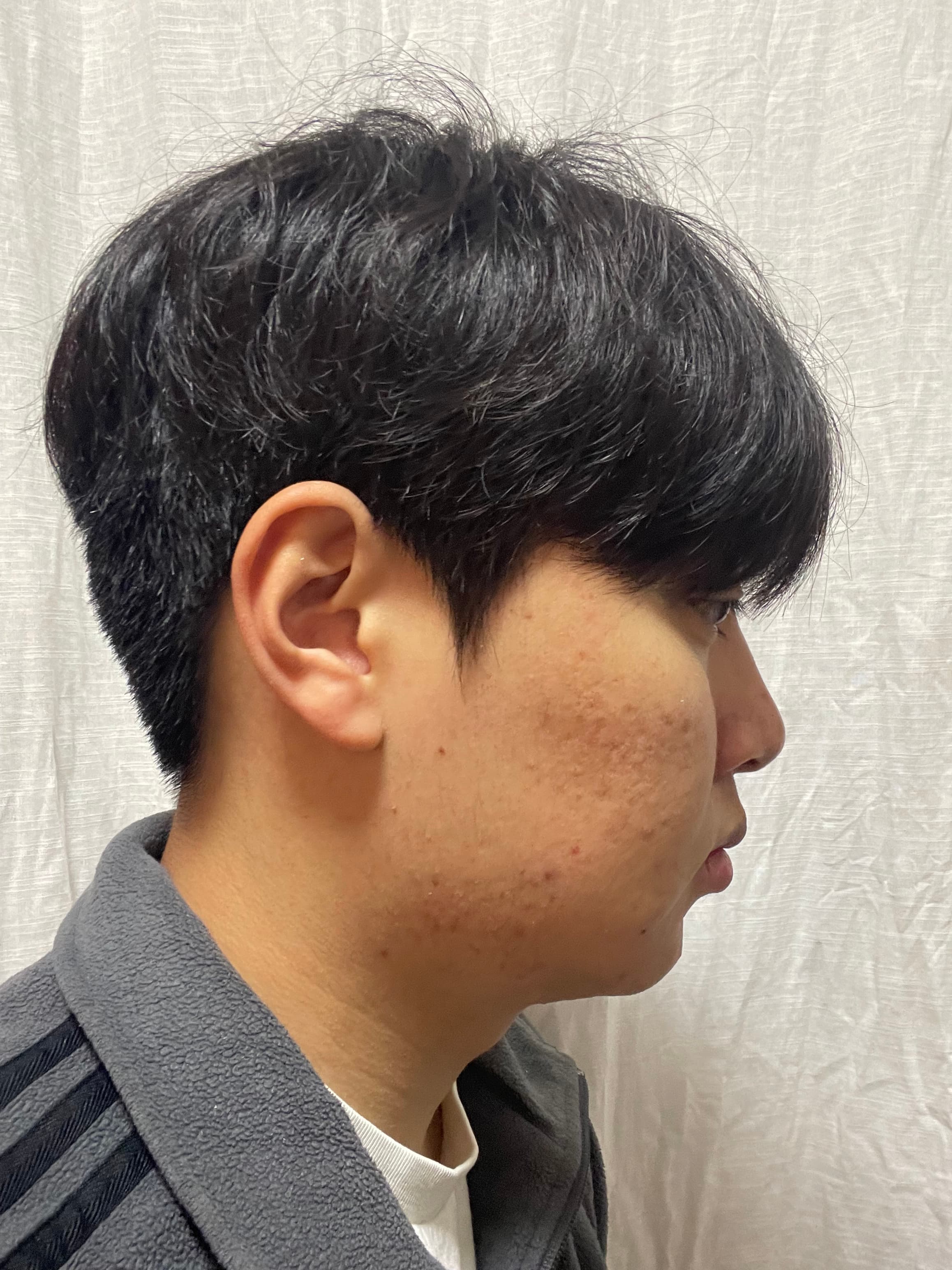 하뉴닾님의 시술후기