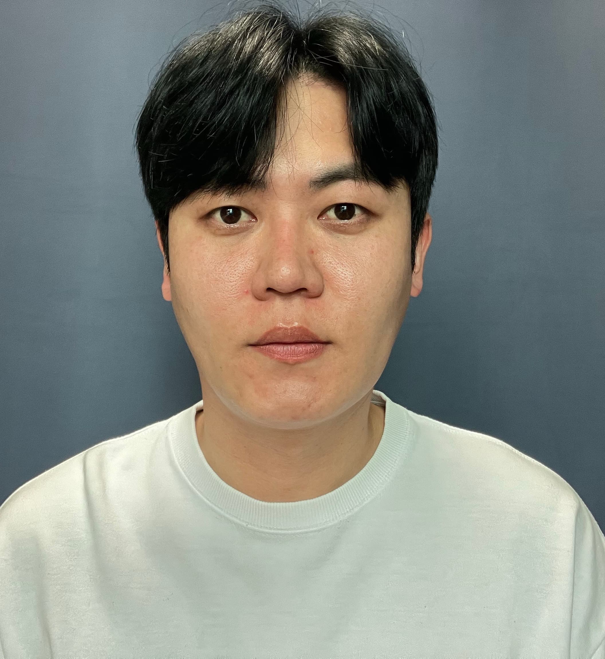 허쉬촠님의 시술후기