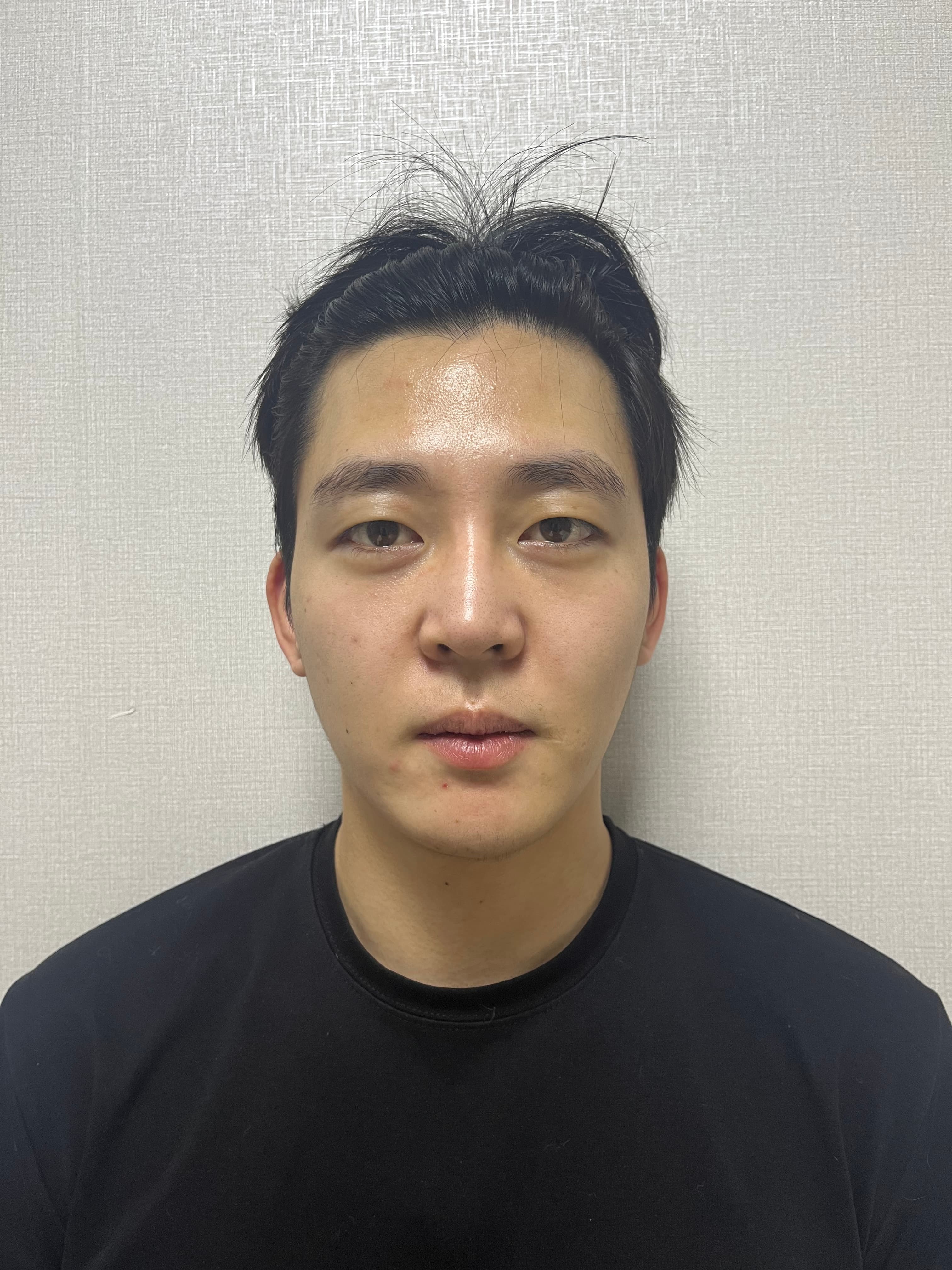 가가이기님의 시술후기