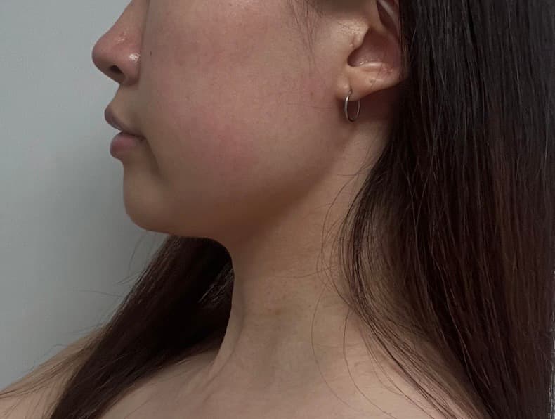 K4759360744님의 시술후기