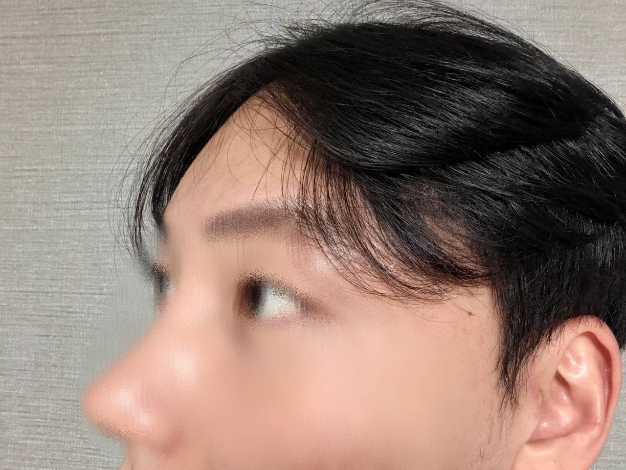 이브븡님의 시술후기