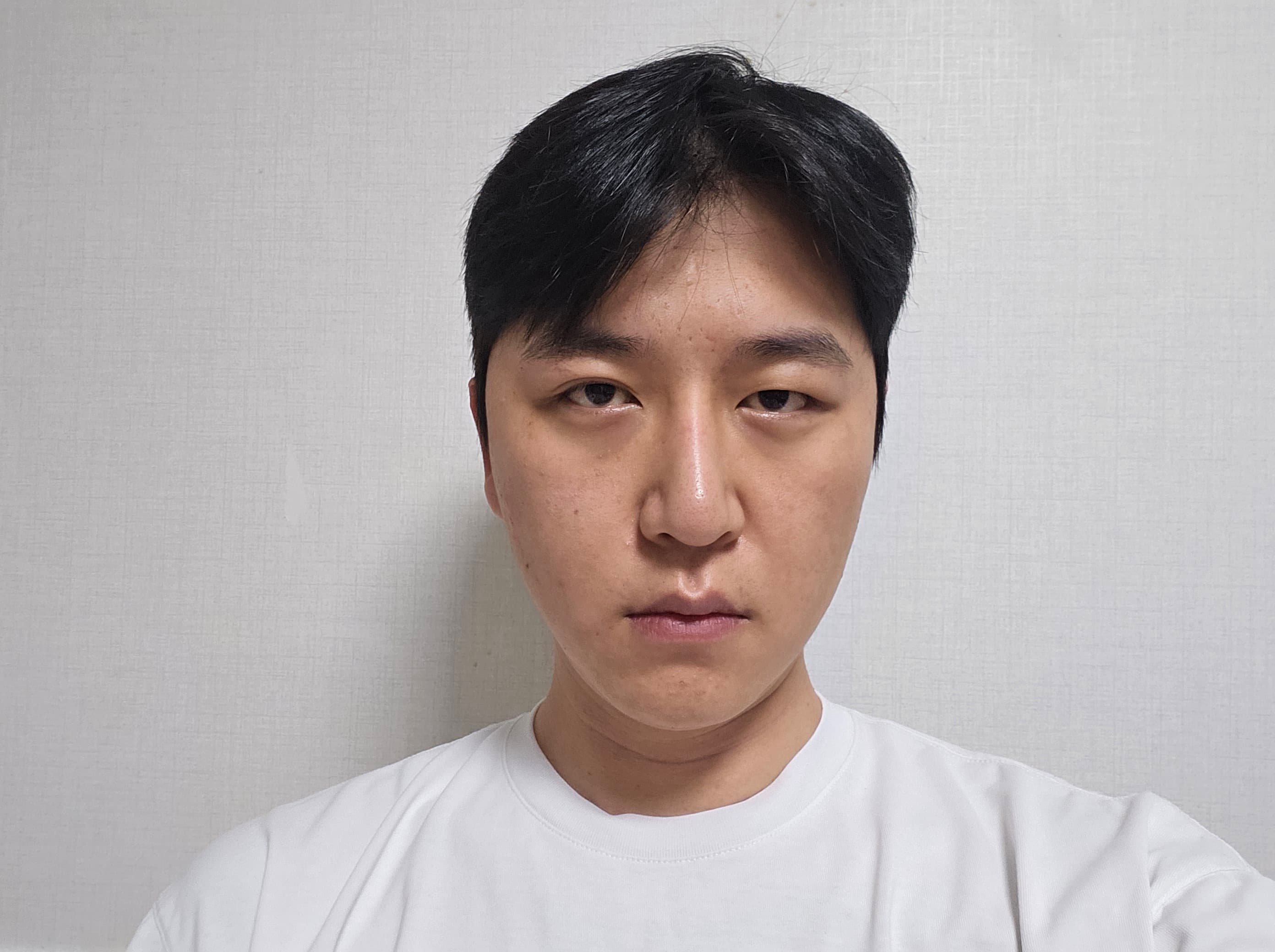 대상이다님의 시술후기