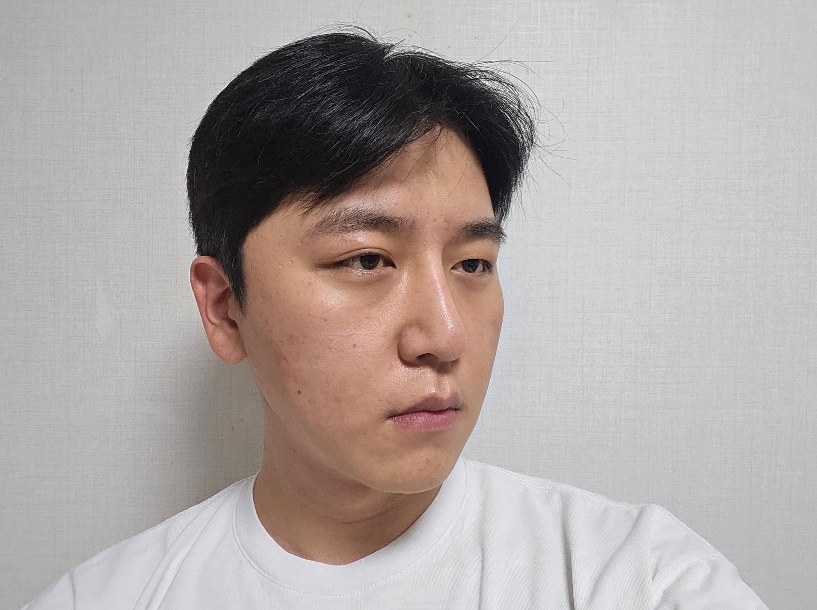 대상이다님의 시술후기