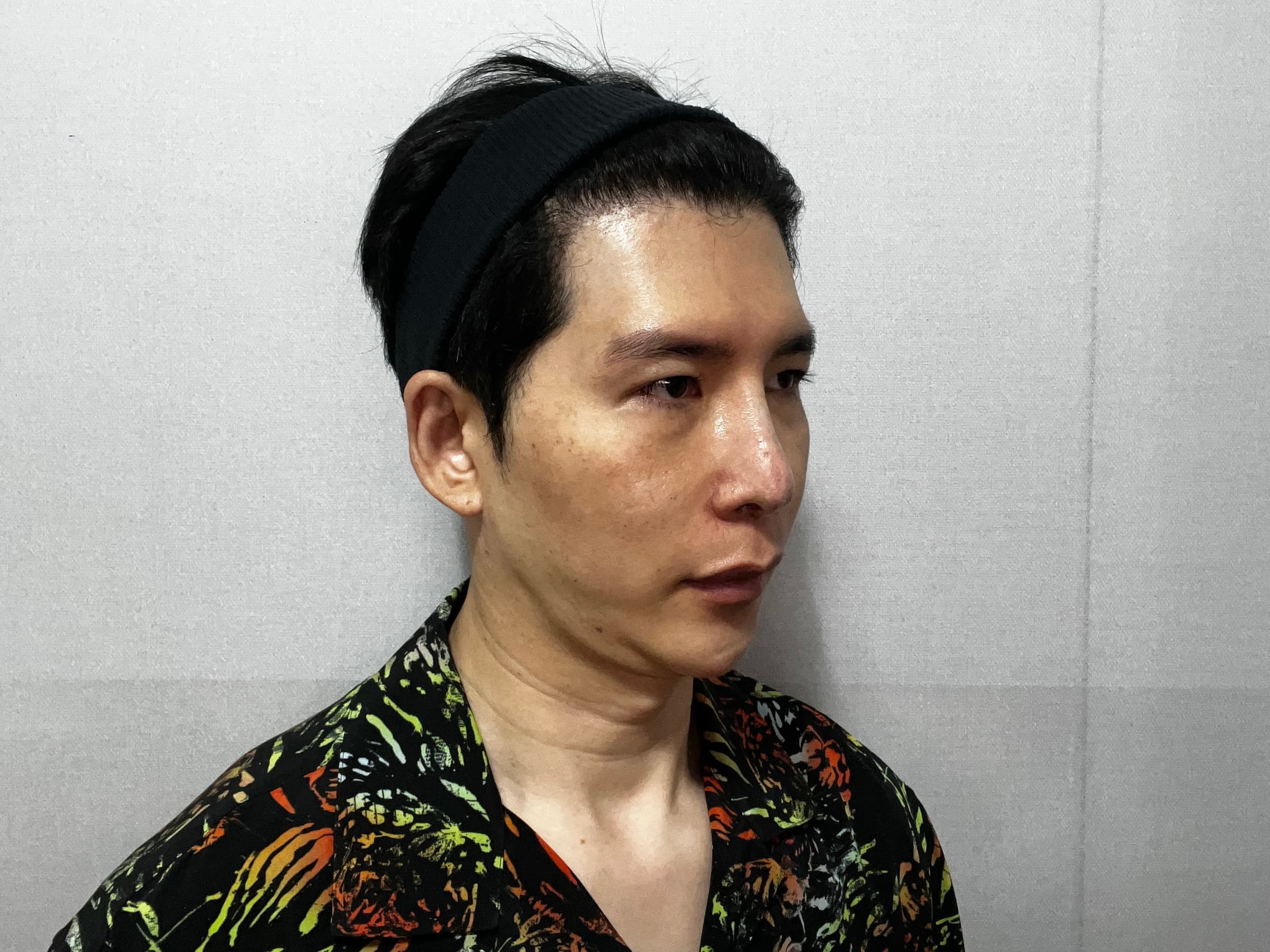 EYDNgj님의 시술후기