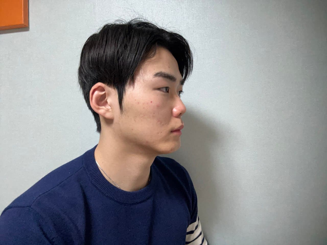 나나랠님의 시술후기
