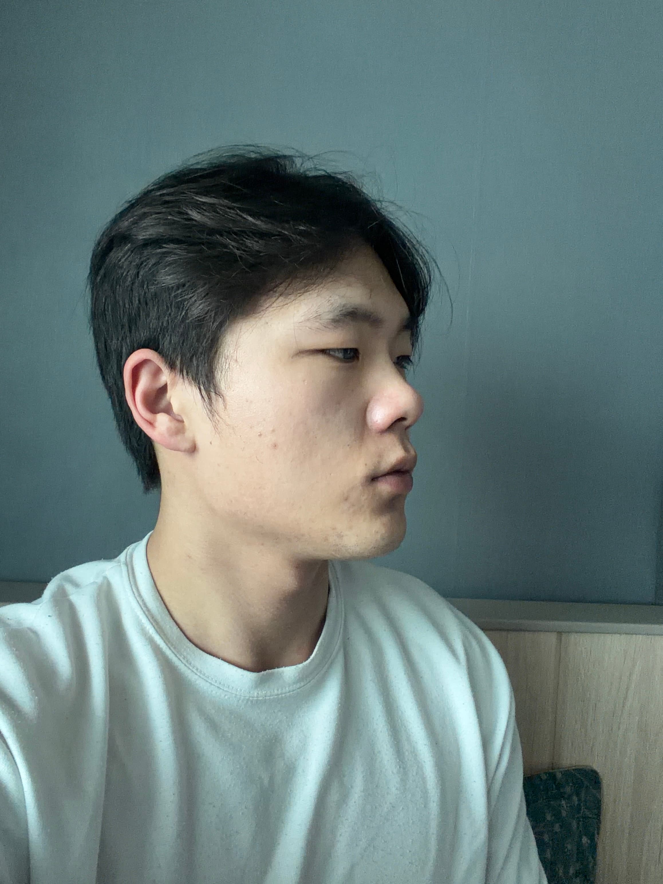 훈훈핳님의 시술후기