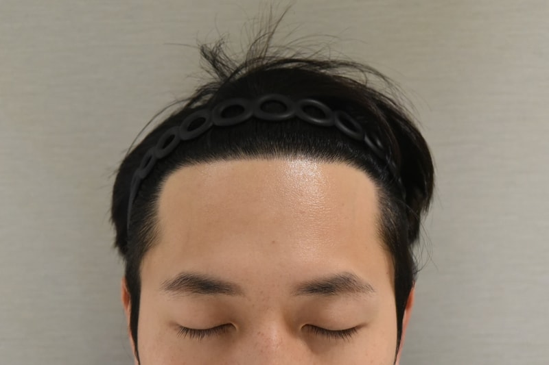 모다올 홍준현 원장님께 받은 수술 1년 경과 후 사진입니다