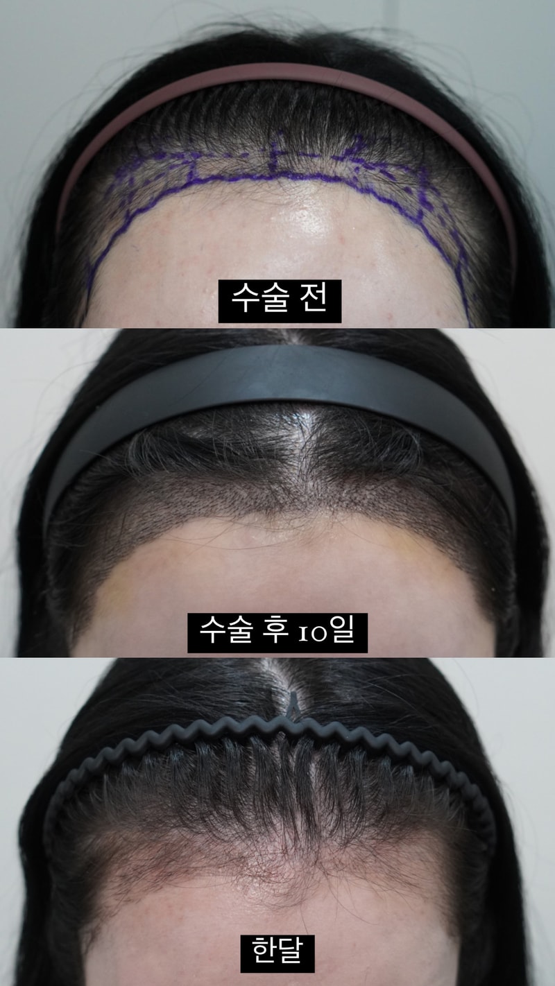 여자 헤어라인 부산모발이식 한 달 차 후기