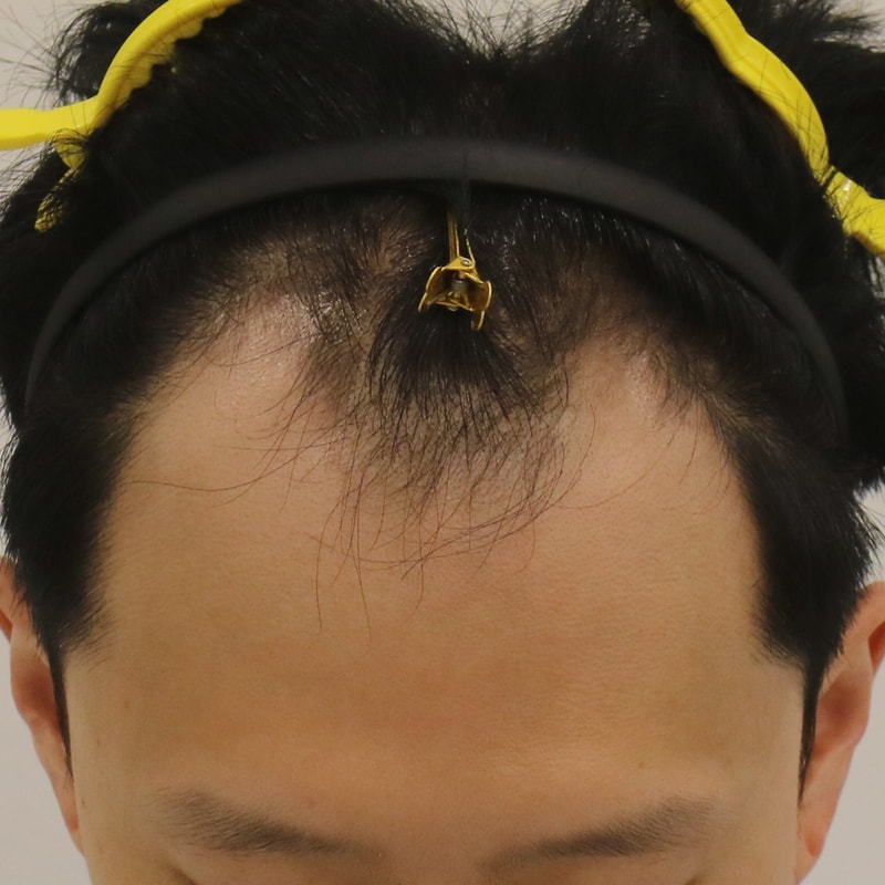 부산 맘모스헤어라인의원 M자 모발이식 2주 경과