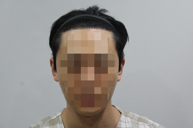 1차 수술 후 6년....뒤 재수술