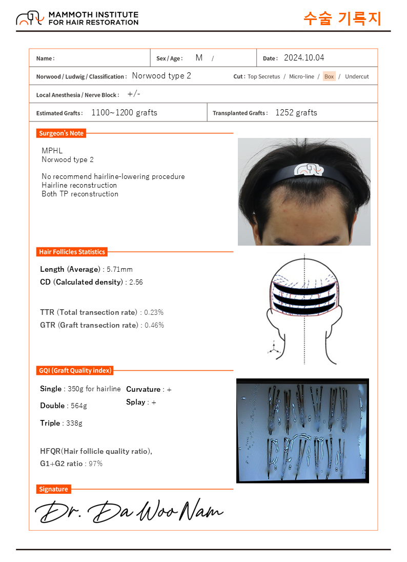 압구정 맘모스헤어라인의원 M자 비절개 모발이식 1일차