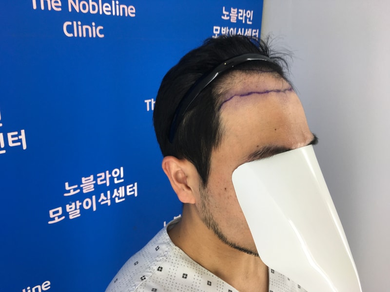 노블라인 백현욱 원장님께 모발이식 받고 왔습니다~
